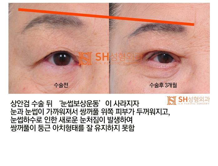 #4 상안검 수술? 상안검 실패의 원인과 분석 사진 5