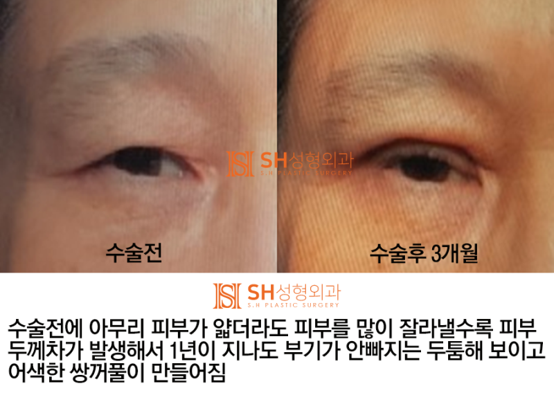 #4 상안검 수술?  상안검 실패의 원인과 분석