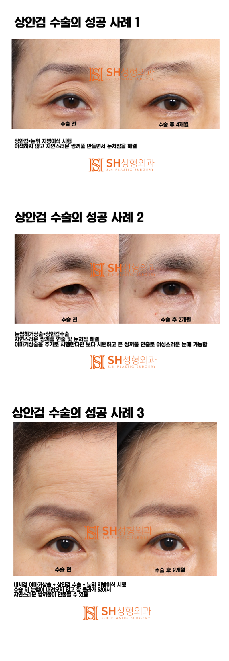 #5 상안검 수술 성공 사례 " 결국 디테일에서 갈립니다!" 사진 4