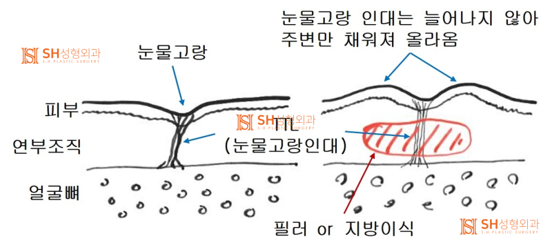 #6 눈밑 주름과 불룩함, 하안검 성형의 진실 사진 7