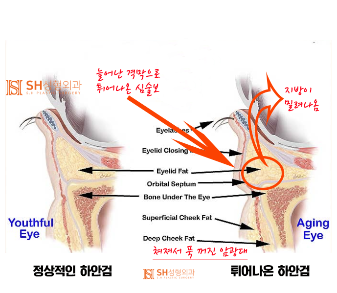 #7 하안검 성형의 선택 – 지방제거 vs 눈밑 지방재배치, 그 차이와 한계 사진 2