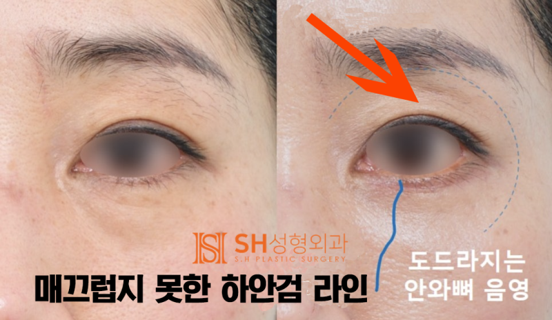 #7 하안검 성형의 선택 – 지방제거 vs 눈밑 지방재배치, 그 차이와 한계