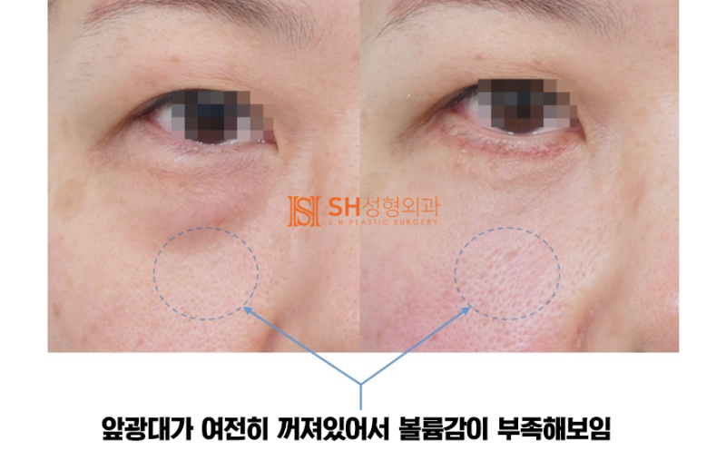 #7 하안검 성형의 선택 – 지방제거 vs 눈밑 지방재배치, 그 차이와 한계 사진 4