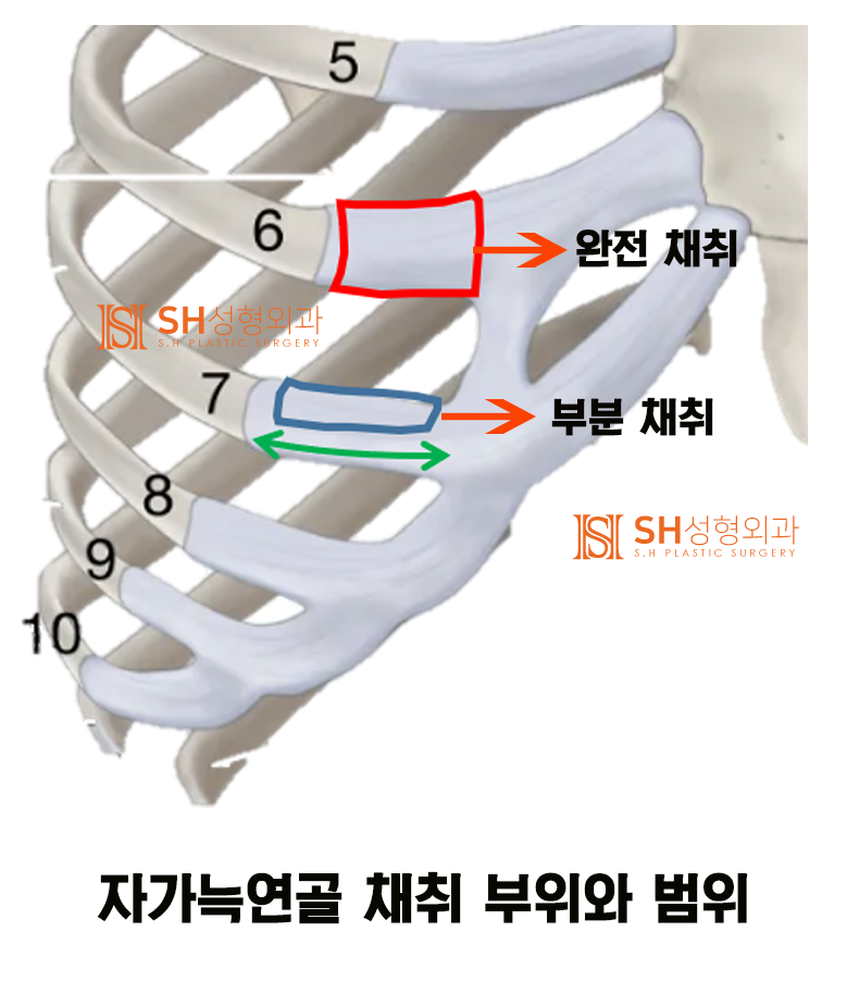 #11 코재수술 자가늑 이유, 코수술 부작용 없이 하는 법 _ 코수술 재료에 대하여 1/3 사진 3
