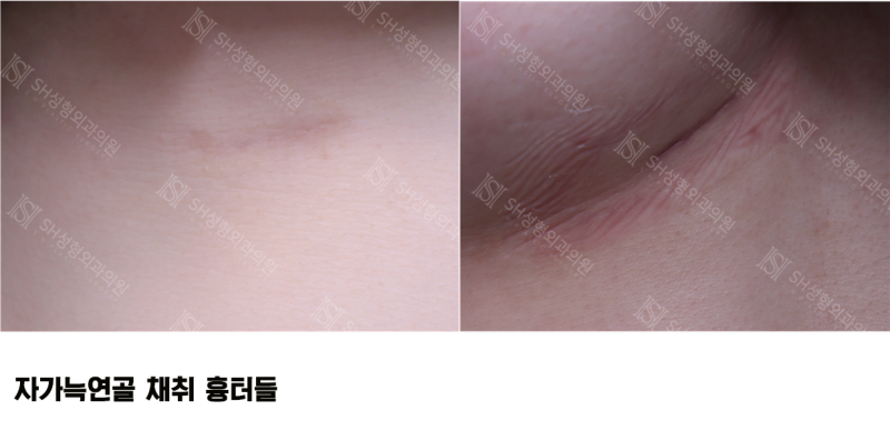 #11 코재수술 자가늑 이유, 코수술 부작용 없이 하는 법 _ 코수술 재료에 대하여 1/3