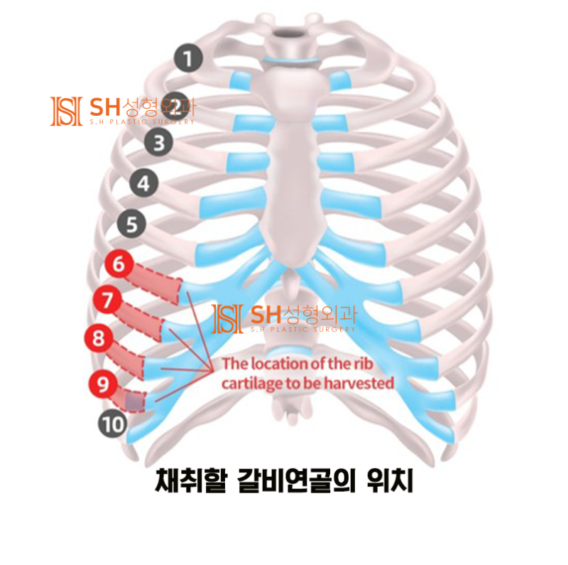 #11 코재수술 자가늑 이유, 코수술 부작용 없이 하는 법 _ 코수술 재료에 대하여 1/3 사진 2
