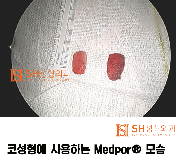 #13 코수술 부작용 원인이 되는 인공재료 코재수술_코수술 재료에 대하여 3/3