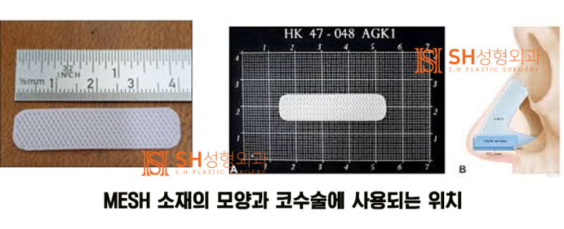 #13 코수술 부작용 원인이 되는 인공재료 코재수술_코수술 재료에 대하여 3/3