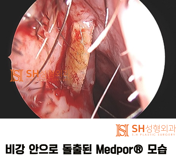 #13 코수술 부작용 원인이 되는 인공재료 코재수술_코수술 재료에 대하여 3/3 사진 2