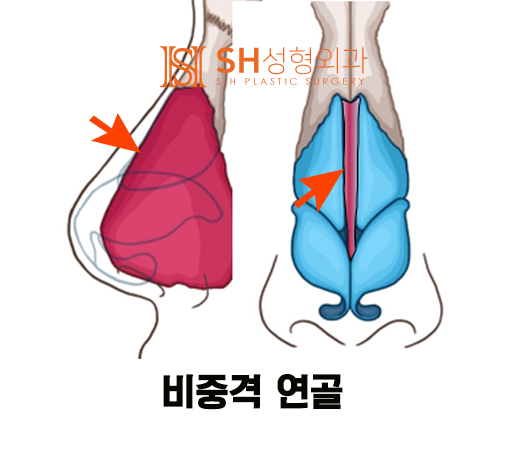 #14 코성형, 코끝 성형 재료, 코 구조부터 알아야 사진 3