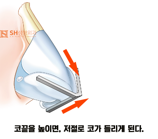 #14 코성형, 코끝 성형 재료, 코 구조부터 알아야 사진 5