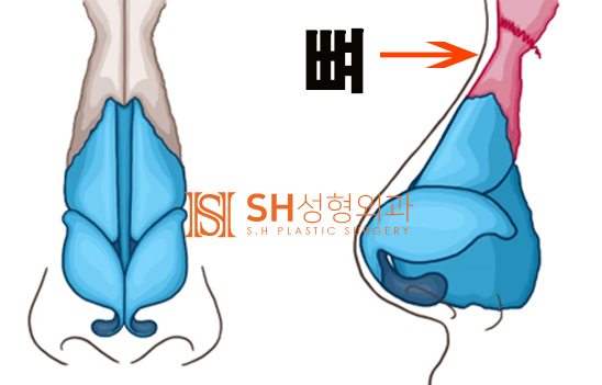 #14 코성형, 코끝 성형 재료, 코 구조부터 알아야