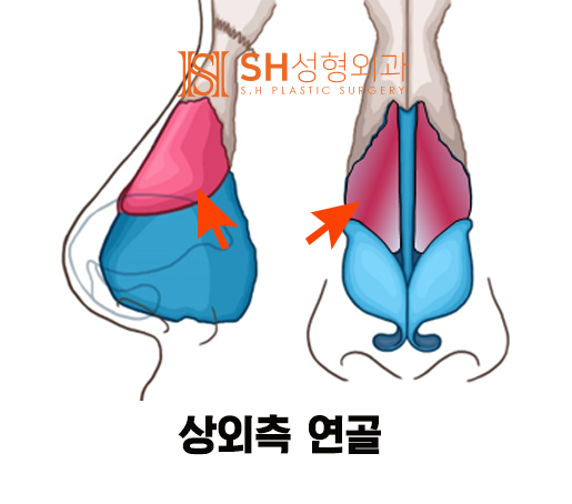 #14 코성형, 코끝 성형 재료, 코 구조부터 알아야 사진 2