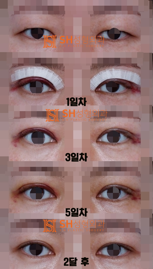 #16 쌍꺼풀 수술 붓기(*부기) 얼마나 가고 어떻게 관리해야 할까?