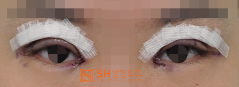 #16 쌍꺼풀 수술 붓기(*부기) 얼마나 가고 어떻게 관리해야 할까? 사진 4
