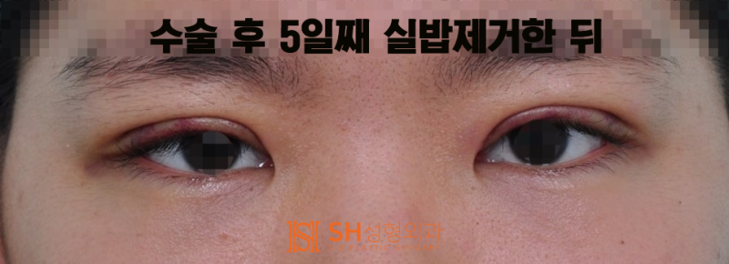 #17 눈매교정 없이 짝눈을 바로잡는 법 — 얼굴디자이너 김성훈 원장의 대칭 디자인 사진 5