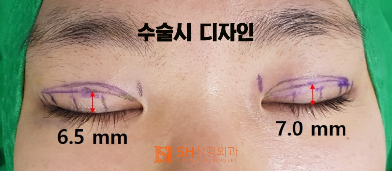 #17 눈매교정 없이 짝눈을 바로잡는 법 — 얼굴디자이너 김성훈 원장의 대칭 디자인 사진 3