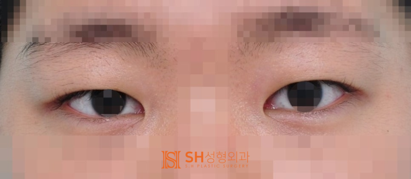 #17 눈매교정 없이 짝눈을 바로잡는 법 — 얼굴디자이너 김성훈 원장의 대칭 디자인 사진 2