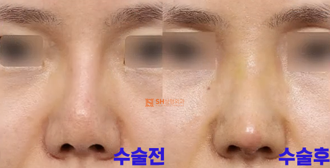 #18 코재수술 후기, 얼마나 달라질 수 있을까요? 사진 3