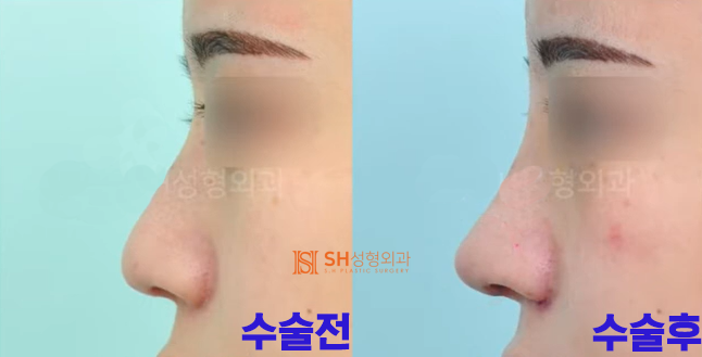 #18 코재수술 후기, 얼마나 달라질 수 있을까요?