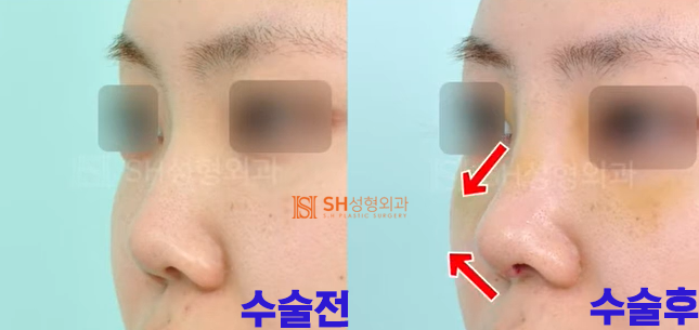 #18 코재수술 후기, 얼마나 달라질 수 있을까요?
