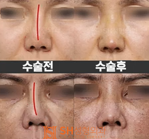 #19 코재수술 부작용 코재수술 사례 _언제 가능하고 어떻게 달라질 수 있을까? 사진 6