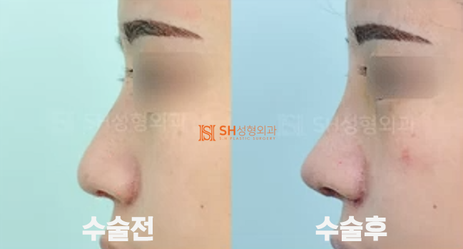 #19 코재수술 부작용 코재수술 사례 _언제 가능하고 어떻게 달라질 수 있을까?