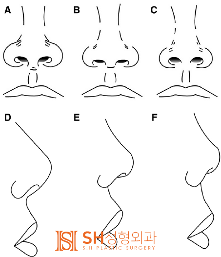 #19 코재수술 부작용 코재수술 사례 _언제 가능하고 어떻게 달라질 수 있을까?