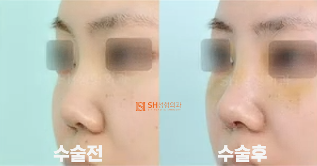 #19 코재수술 부작용 코재수술 사례 _언제 가능하고 어떻게 달라질 수 있을까? 사진 4