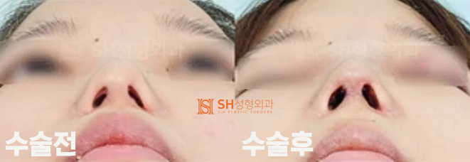 #19 코재수술 부작용 코재수술 사례 _언제 가능하고 어떻게 달라질 수 있을까? 사진 5