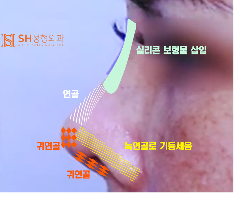 #20 구축코 재수술 무너진 코, 다시 되살릴 수 있을까? 사진 7