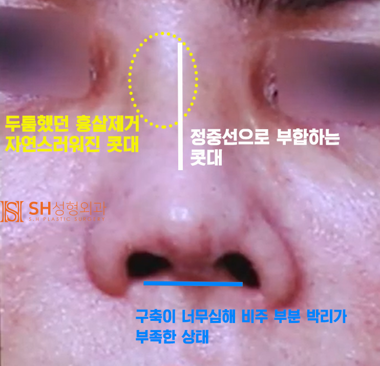 #20 구축코 재수술 무너진 코, 다시 되살릴 수 있을까? 사진 8