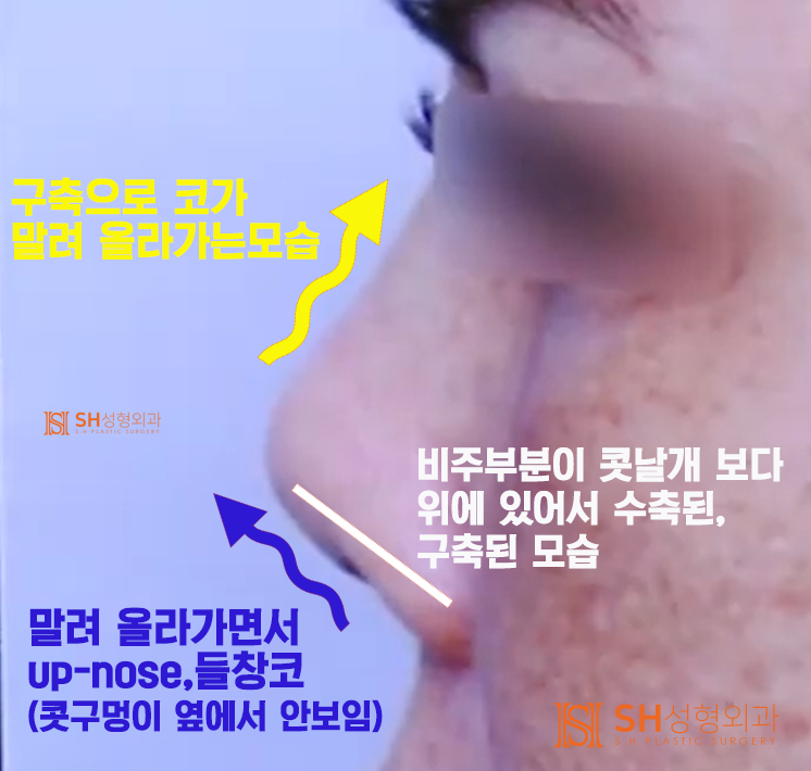 #20 구축코 재수술 무너진 코, 다시 되살릴 수 있을까? 사진 4