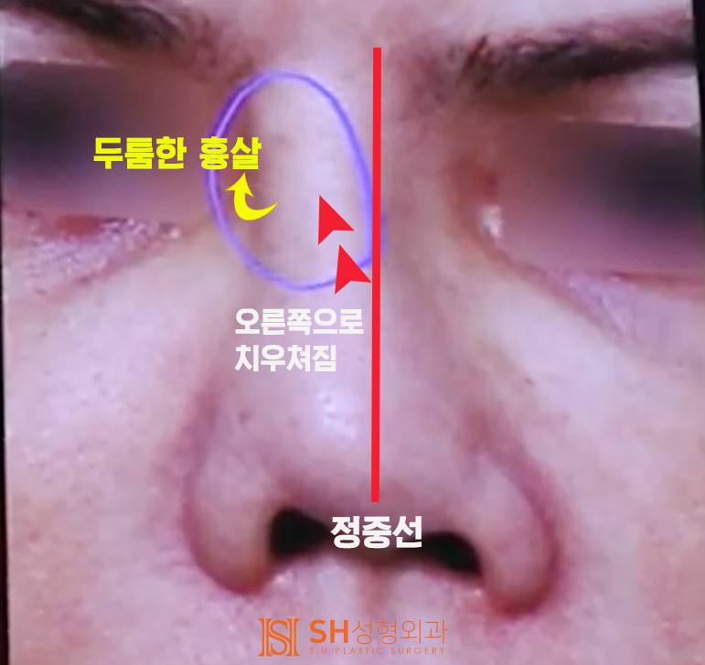 #20 구축코 재수술 무너진 코, 다시 되살릴 수 있을까? 사진 2