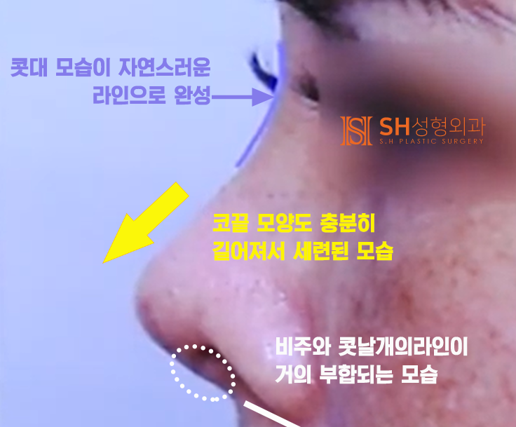 #20 구축코 재수술 무너진 코, 다시 되살릴 수 있을까?