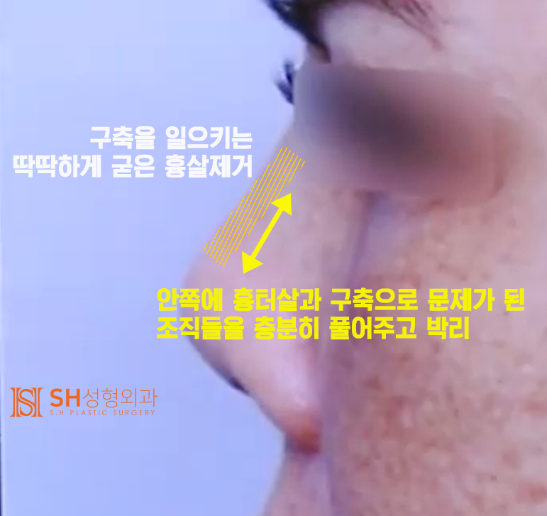 #20 구축코 재수술 무너진 코, 다시 되살릴 수 있을까? 사진 6