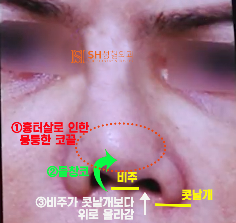 #20 구축코 재수술 무너진 코, 다시 되살릴 수 있을까? 사진 3