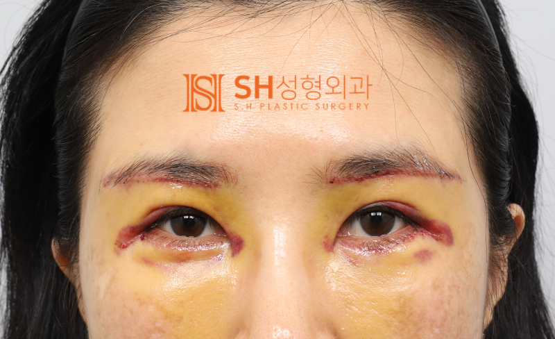 #25 눈썹하거상 윗트임 하안검 복합수술 50대 여성 케이스 분석 사진 6
