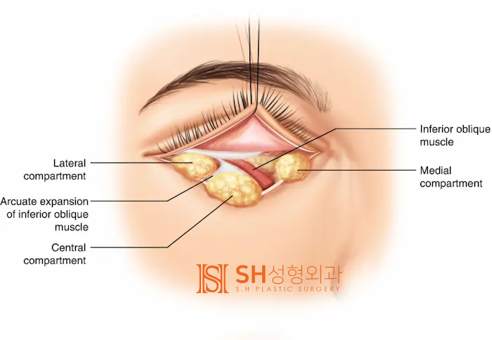 #25 눈썹하거상 윗트임 하안검 복합수술 50대 여성 케이스 분석 사진 3