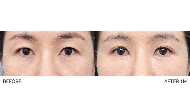 #25 눈썹하거상 윗트임 하안검 복합수술 50대 여성 케이스 분석