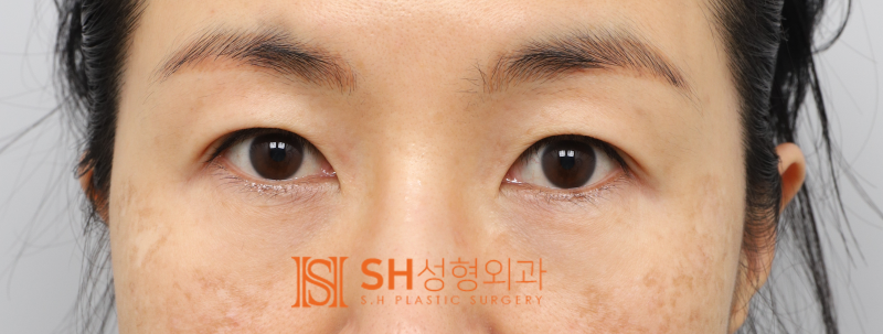 #25 눈썹하거상 윗트임 하안검 복합수술 50대 여성 케이스 분석