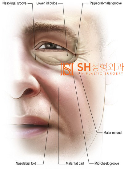#25 눈썹하거상 윗트임 하안검 복합수술 50대 여성 케이스 분석 사진 4