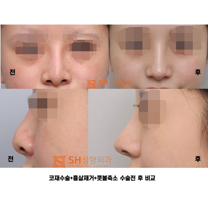 #27 코재수술 후기, 무엇이 달라졌을까? 코끝 수술 보형물교체, 흉살제거는 지지구조를 이해해야 사진 9