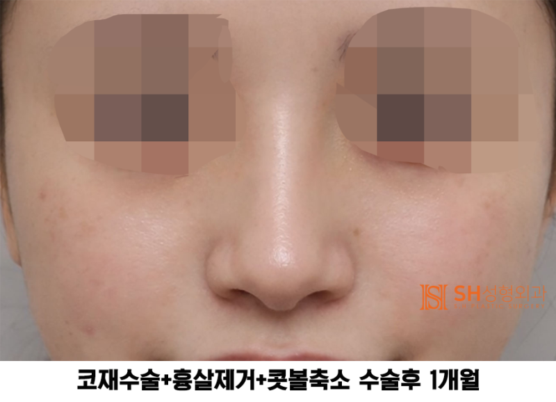 #27 코재수술 후기, 무엇이 달라졌을까? 코끝 수술 보형물교체, 흉살제거는 지지구조를 이해해야 사진 6