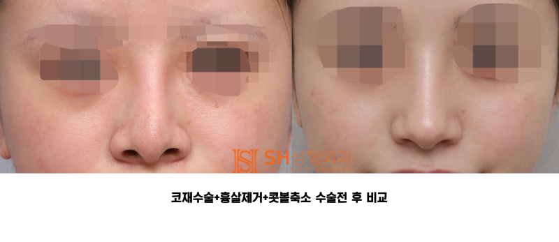 #27 코재수술 후기, 무엇이 달라졌을까? 코끝 수술 보형물교체, 흉살제거는 지지구조를 이해해야 사진 2