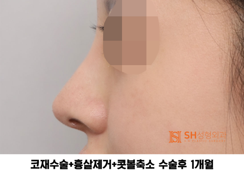 #27 코재수술 후기, 무엇이 달라졌을까? 코끝 수술 보형물교체, 흉살제거는 지지구조를 이해해야 사진 7