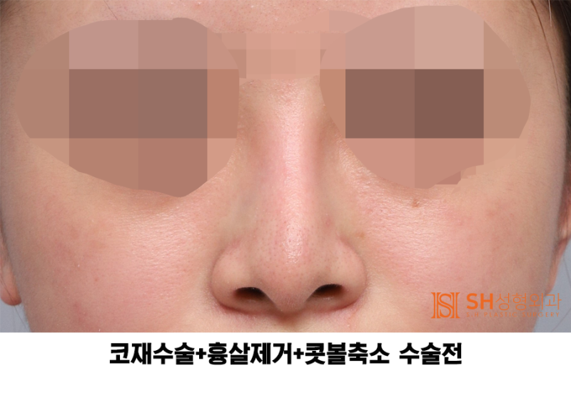 #27 코재수술 후기, 무엇이 달라졌을까? 코끝 수술 보형물교체, 흉살제거는 지지구조를 이해해야 사진 3