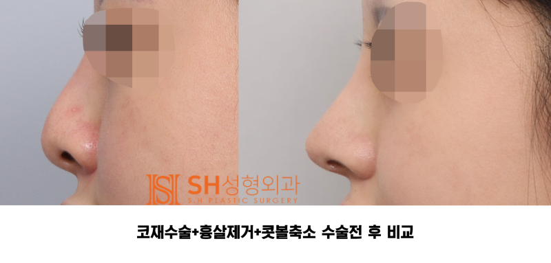 #27 코재수술 후기, 무엇이 달라졌을까? 코끝 수술 보형물교체, 흉살제거는 지지구조를 이해해야