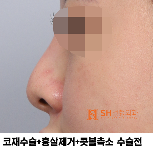 #27 코재수술 후기, 무엇이 달라졌을까? 코끝 수술 보형물교체, 흉살제거는 지지구조를 이해해야 사진 4