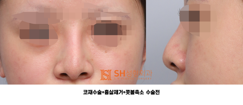 #27 코재수술 후기, 무엇이 달라졌을까? 코끝 수술 보형물교체, 흉살제거는 지지구조를 이해해야 사진 5